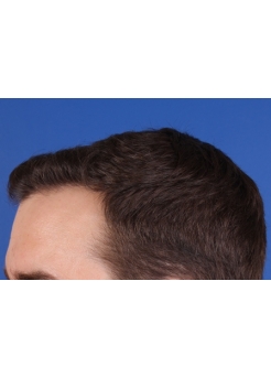 After Hair Transplant&nbsp;Hairlines